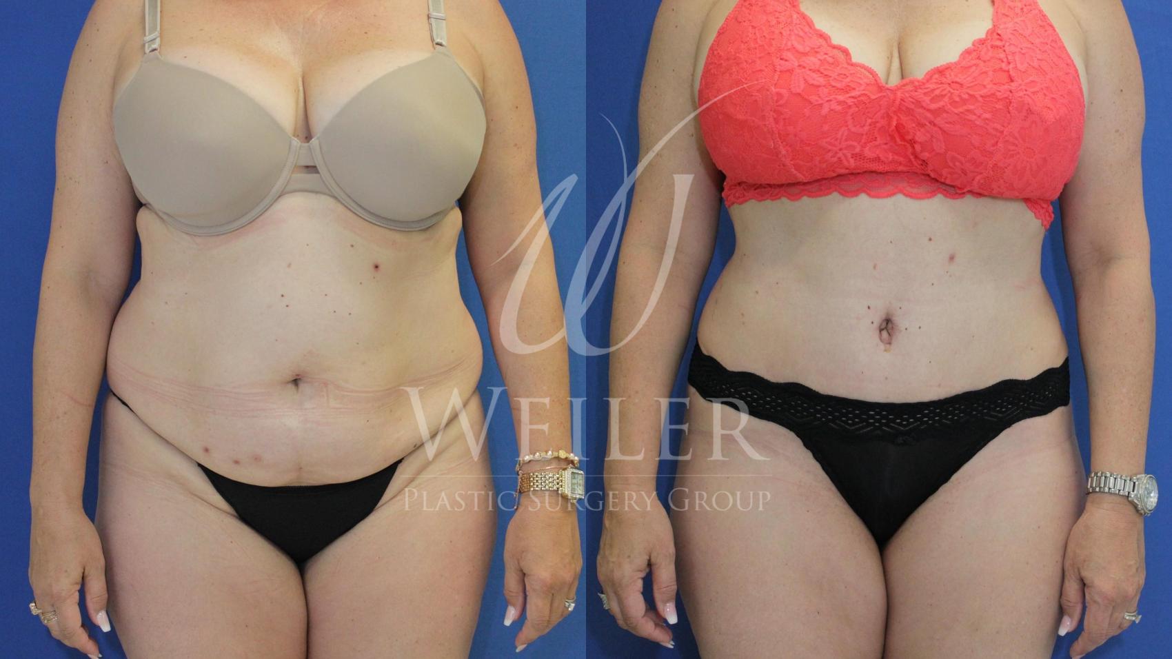Before & After Tummy Tuck Case 478 Front View in Baton Rouge, Louisiana