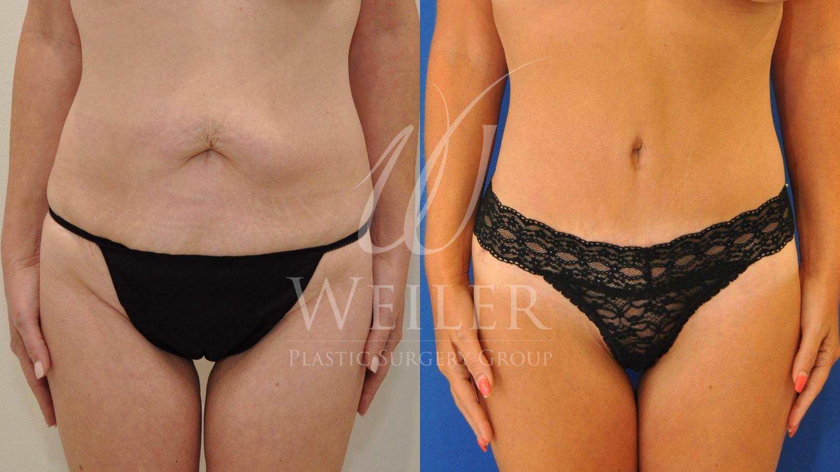 Before & After Tummy Tuck Case 482 Front View in Baton Rouge, Louisiana