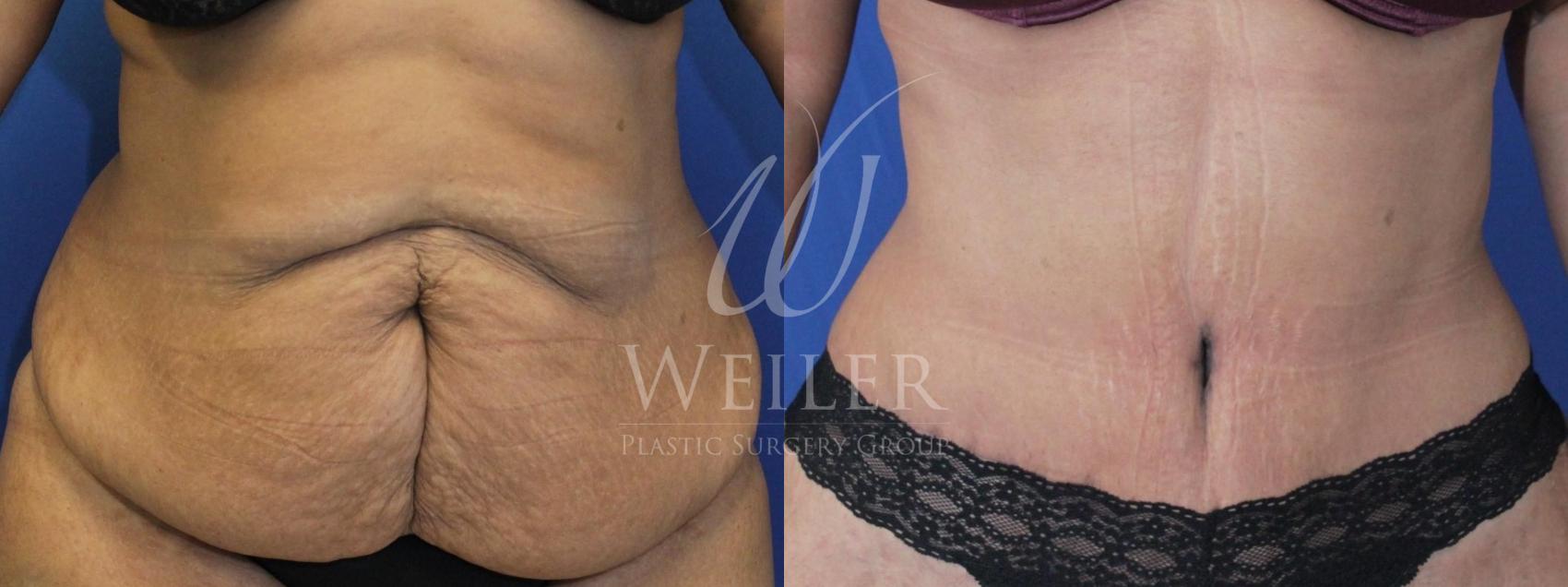Before & After Tummy Tuck Case 483 Front View in Baton Rouge, Louisiana