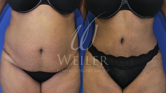 Before & After Tummy Tuck Case 488 Front View in Baton Rouge, Louisiana