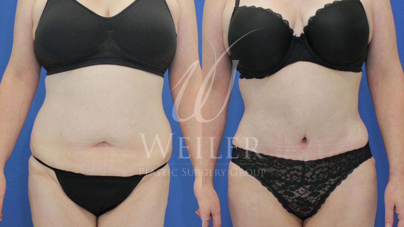 Before & After Tummy Tuck Case 494 Front View in Baton Rouge, New Orleans, & Lafayette, Louisiana
