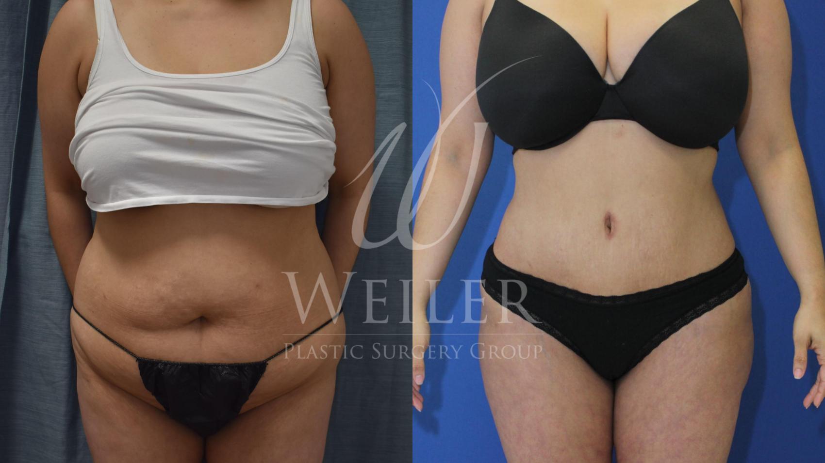 Before & After Tummy Tuck Case 499 Front View in Baton Rouge, Louisiana