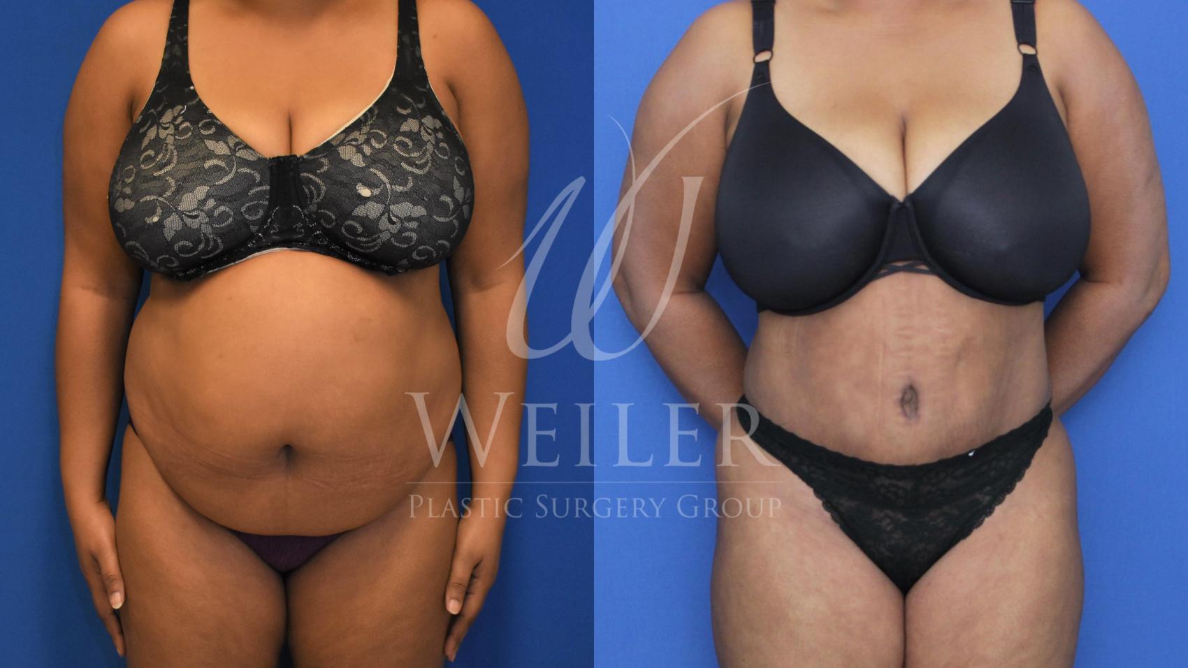 Before & After Tummy Tuck Case 530 Front View in Baton Rouge, New Orleans, & Lafayette, Louisiana