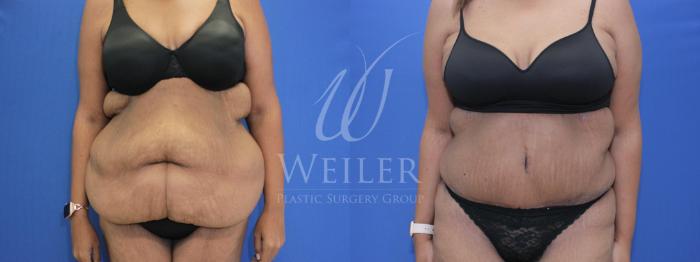 Before & After Tummy Tuck Case 533 Front View in Baton Rouge, New Orleans, & Lafayette, Louisiana