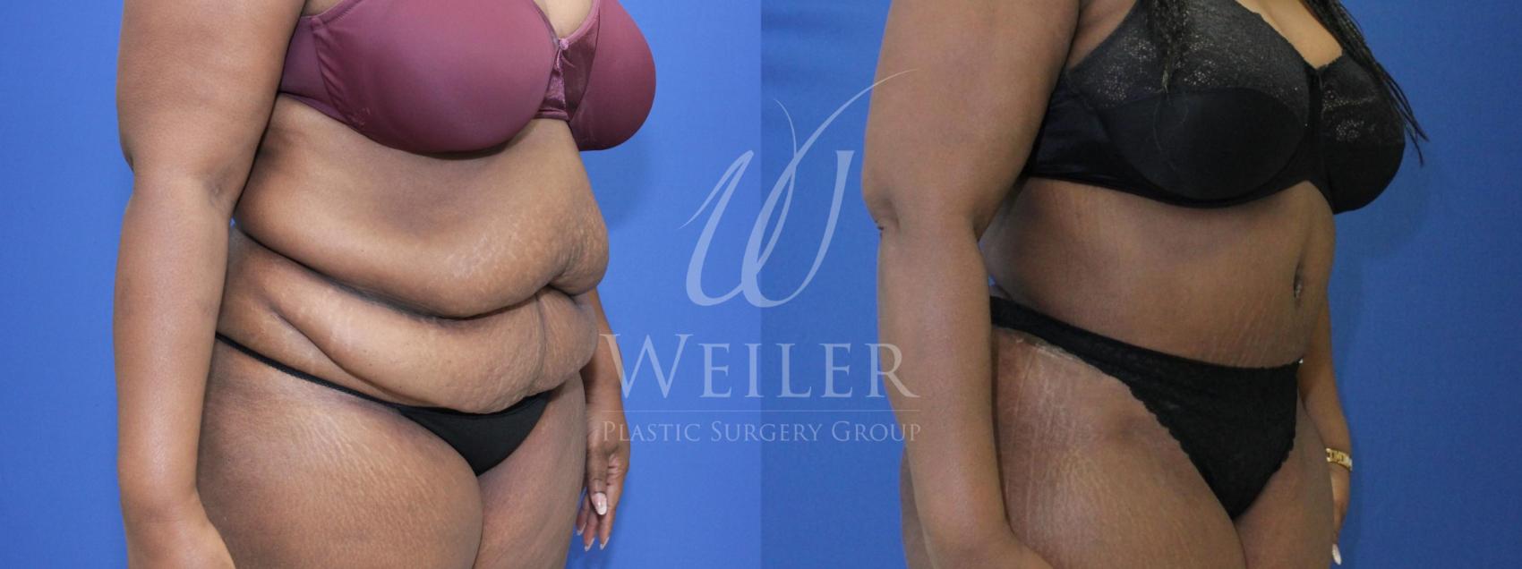 Before & After Tummy Tuck Case 563 Right Oblique View in Baton Rouge, Louisiana