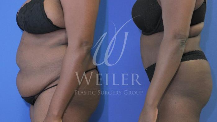 Before & After Tummy Tuck Case 569 Left Side View in Baton Rouge, New Orleans, & Lafayette, Louisiana