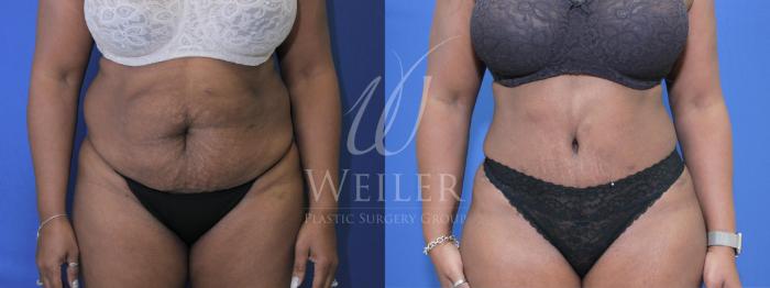 Before & After Tummy Tuck Case 570 Front View in Baton Rouge, Louisiana