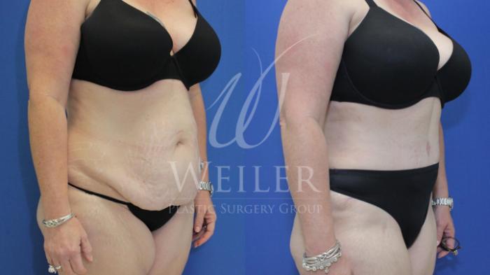 Before & After Tummy Tuck Case 594 Right Oblique View in Baton Rouge, New Orleans, & Lafayette, Louisiana
