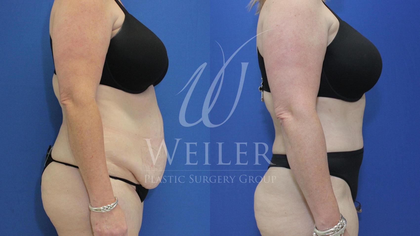 Before & After Tummy Tuck Case 594 Right Side View in Baton Rouge, New Orleans, & Lafayette, Louisiana