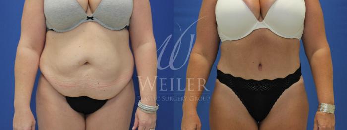 Before & After Tummy Tuck Case 628 Front View in Baton Rouge, New Orleans, & Lafayette, Louisiana