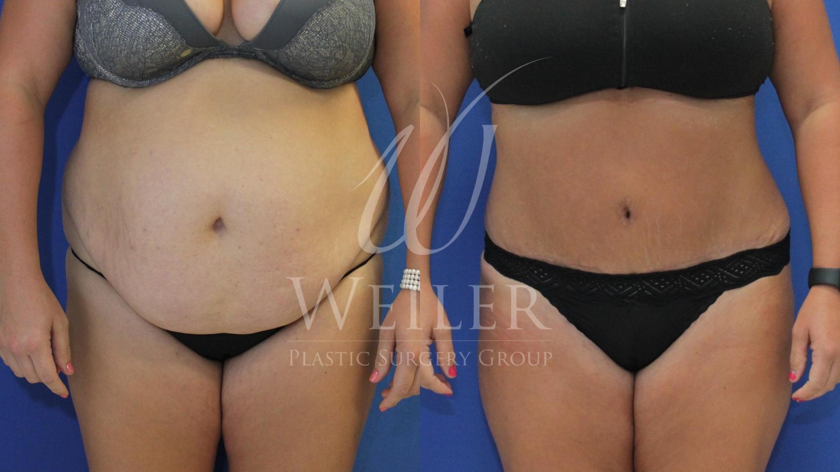 Before & After Tummy Tuck Case 637 Front View in Baton Rouge, New Orleans, & Lafayette, Louisiana