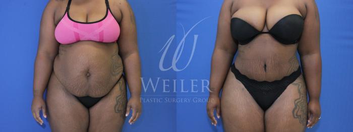 Before & After Tummy Tuck Case 654 Front View in Baton Rouge, New Orleans, & Lafayette, Louisiana