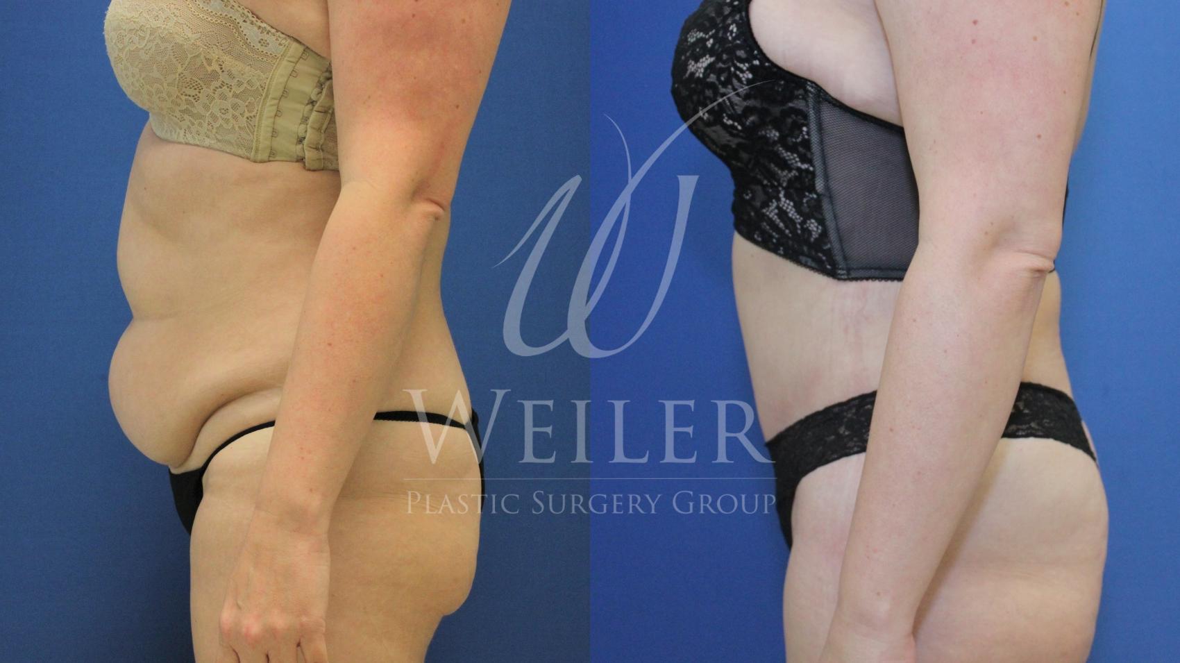 Before & After Tummy Tuck Case 659 Left Side View in Baton Rouge, New Orleans, & Lafayette, Louisiana