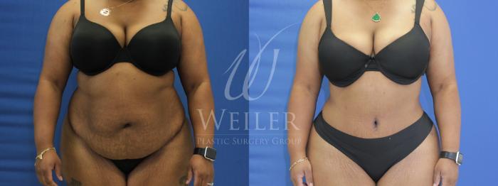 Before & After Tummy Tuck Case 682 Front  View in Baton Rouge, New Orleans, & Lafayette, Louisiana