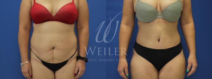 Before & After Tummy Tuck Case 686 Front View in Baton Rouge, New Orleans, & Lafayette, Louisiana