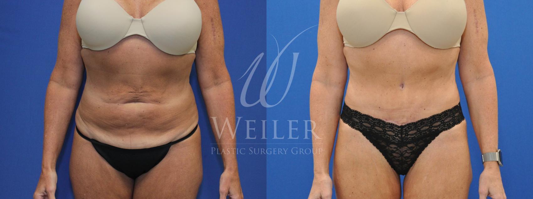 Before & After Tummy Tuck Case 688 Front View in Baton Rouge, New Orleans, & Lafayette, Louisiana