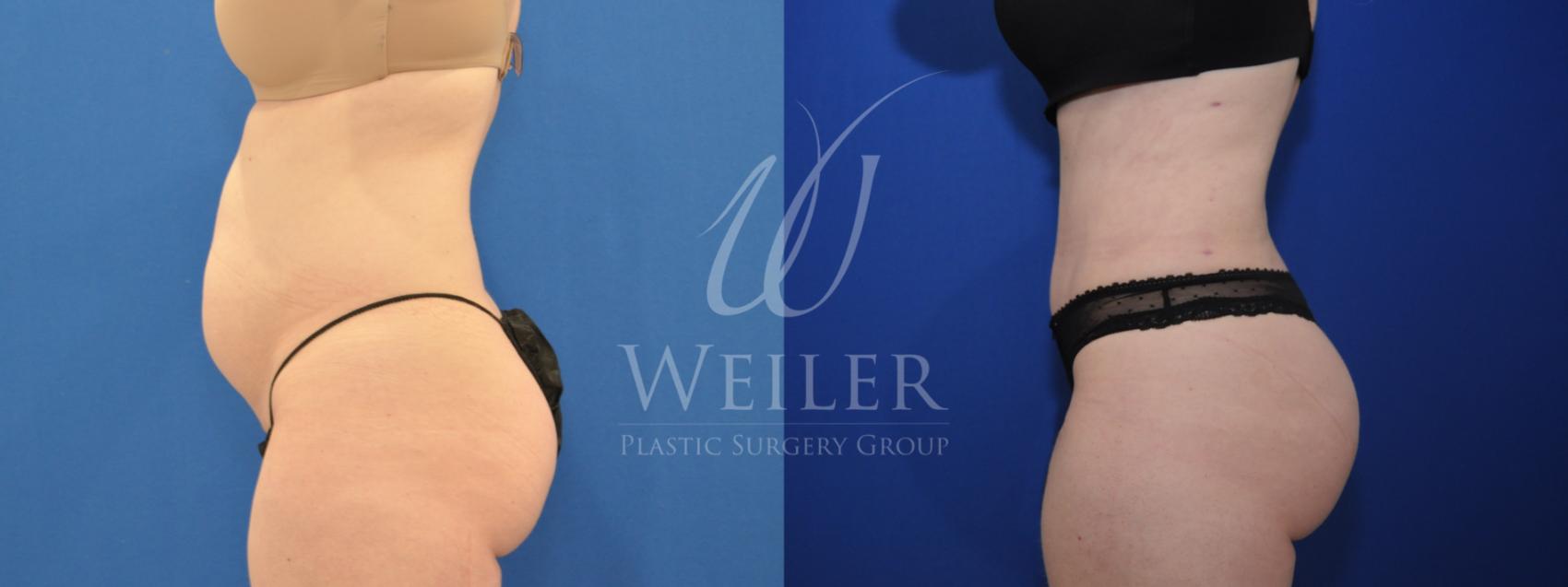 Before & After Tummy Tuck Case 691 Left Side View in Baton Rouge, New Orleans, & Lafayette, Louisiana
