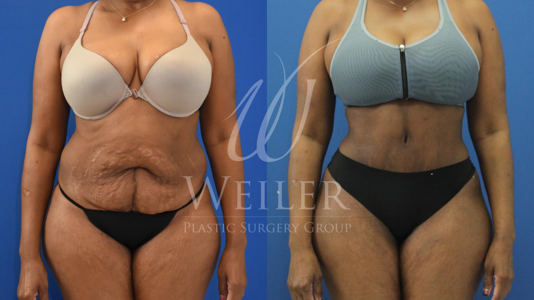 Before & After Tummy Tuck Case 703 Front View in Baton Rouge, Louisiana