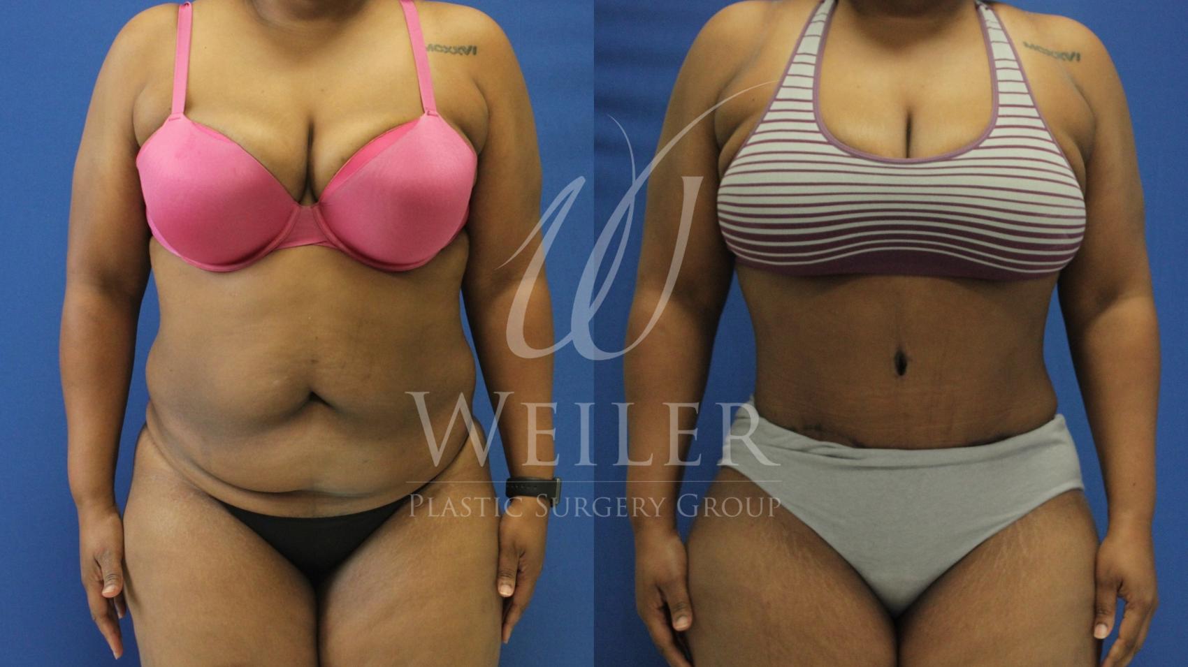 Before & After Tummy Tuck Case 705 Front View in Baton Rouge, New Orleans, & Lafayette, Louisiana