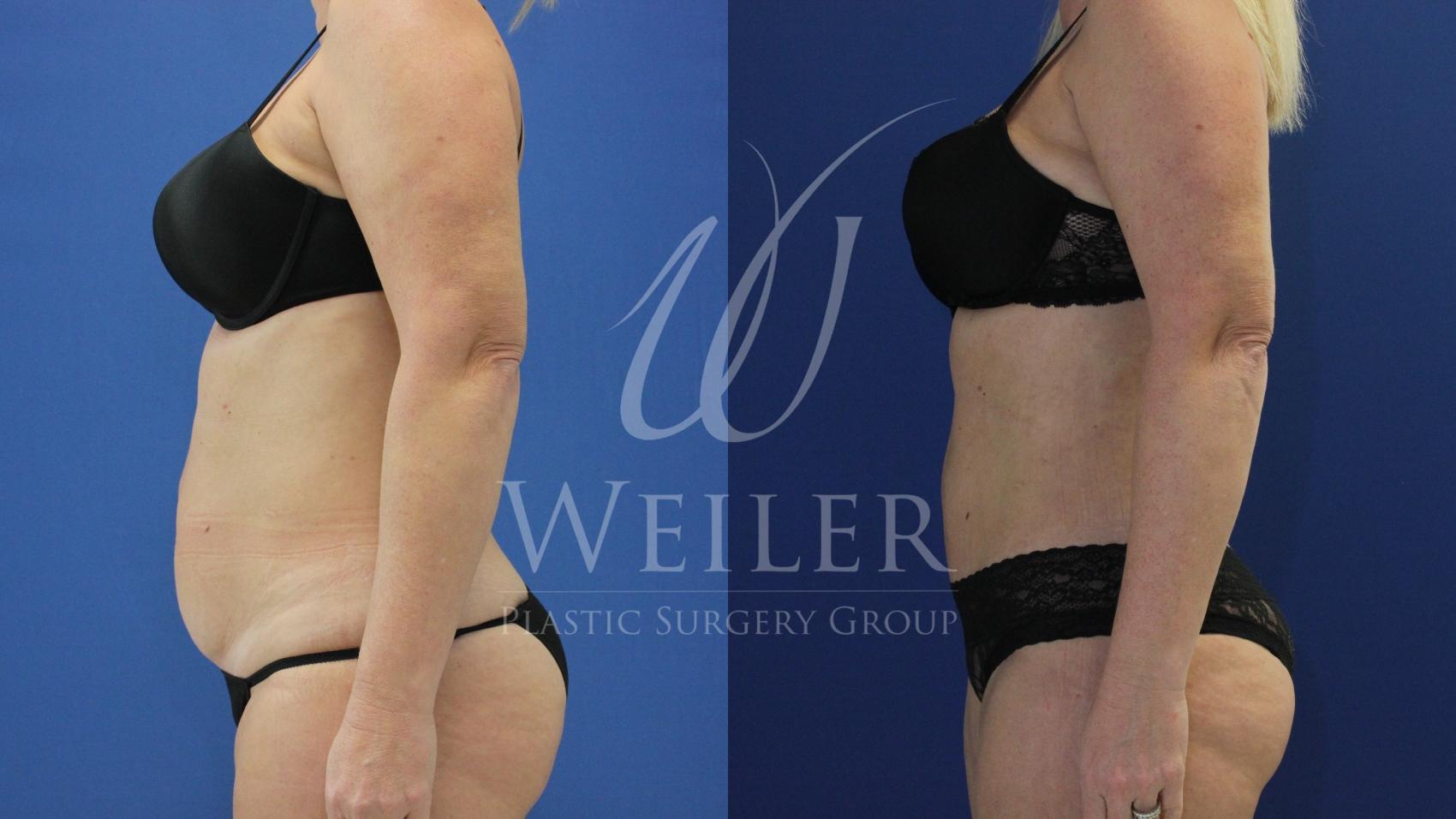 Before & After Tummy Tuck Case 706 Left Side View in Baton Rouge, Louisiana