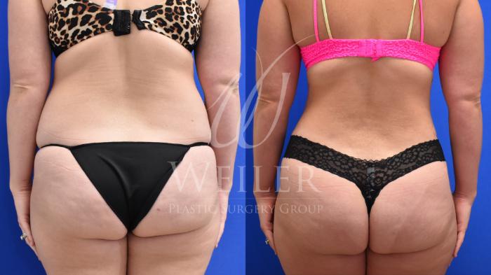 Before & After Tummy Tuck Case 728 Back View in Baton Rouge, New Orleans, & Lafayette, Louisiana