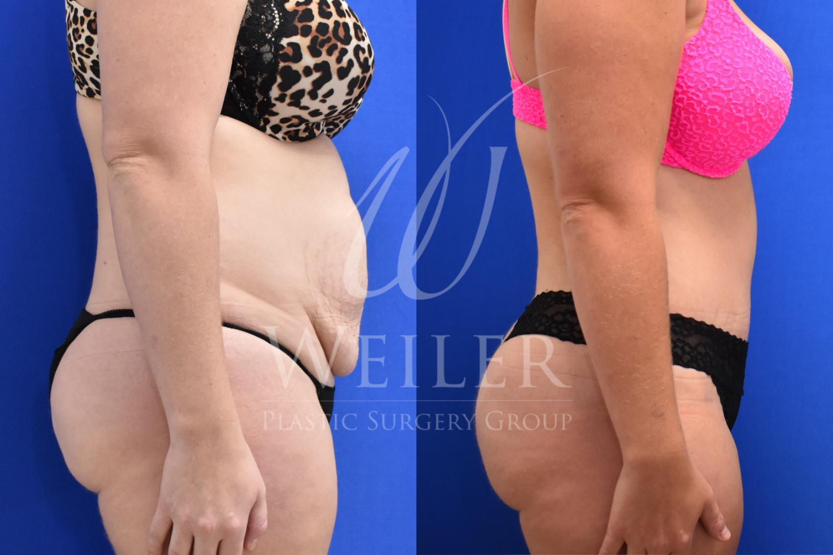 Before & After Tummy Tuck Case 728 Right Oblique View in Baton Rouge, Louisiana
