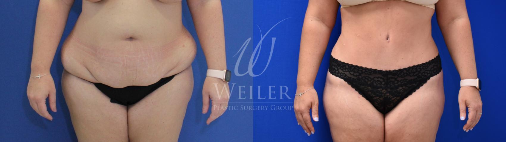 Before & After Tummy Tuck Case 731 Front View in Baton Rouge, Louisiana