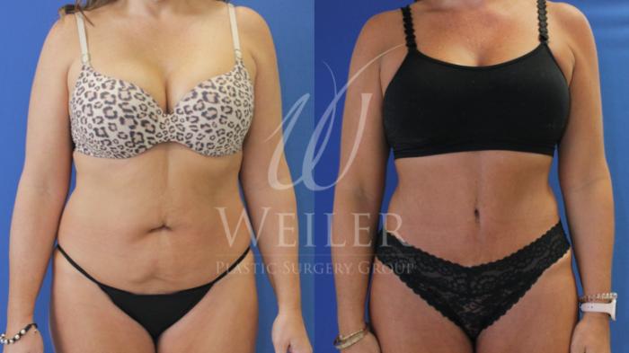 Before & After Tummy Tuck Case 760 Front View in Baton Rouge, New Orleans, & Lafayette, Louisiana