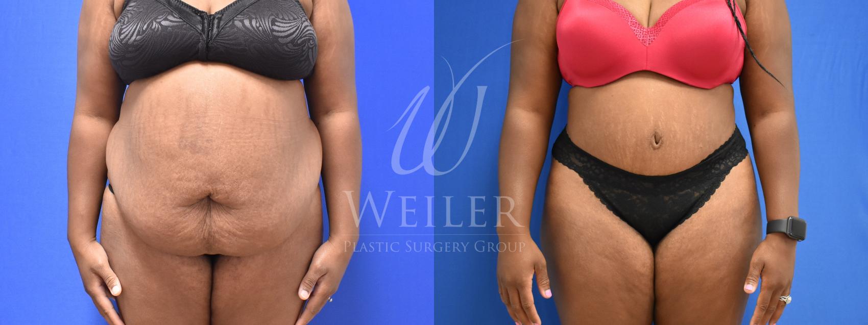 Before & After Tummy Tuck Case 761 Front View in Baton Rouge, New Orleans, & Lafayette, Louisiana