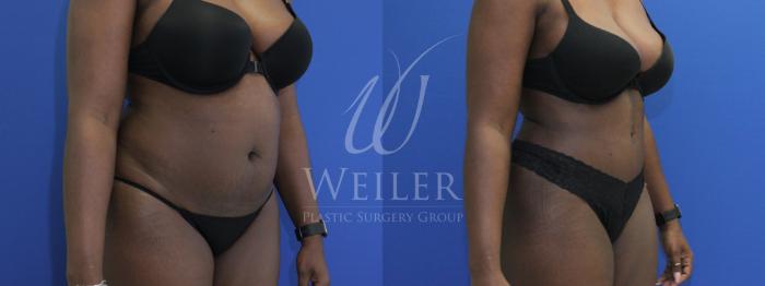 Before & After Tummy Tuck Case 763 Right Oblique View in Baton Rouge, Louisiana