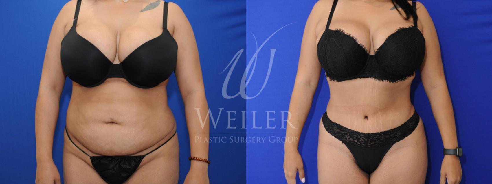 Before & After Tummy Tuck Case 779 Front View in Baton Rouge, Louisiana