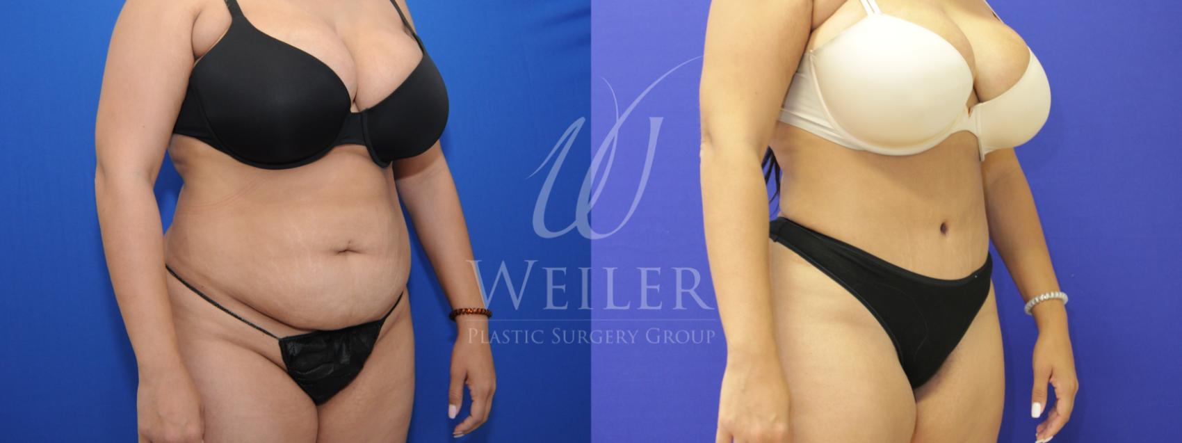 Before & After Tummy Tuck Case 779 Right Oblique View in Baton Rouge, Louisiana