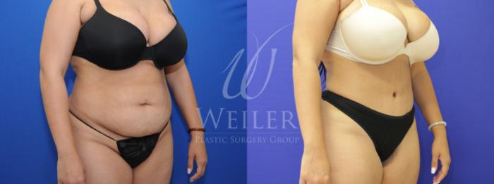 Before & After Tummy Tuck Case 779 Right Oblique View in Baton Rouge, New Orleans, & Lafayette, Louisiana