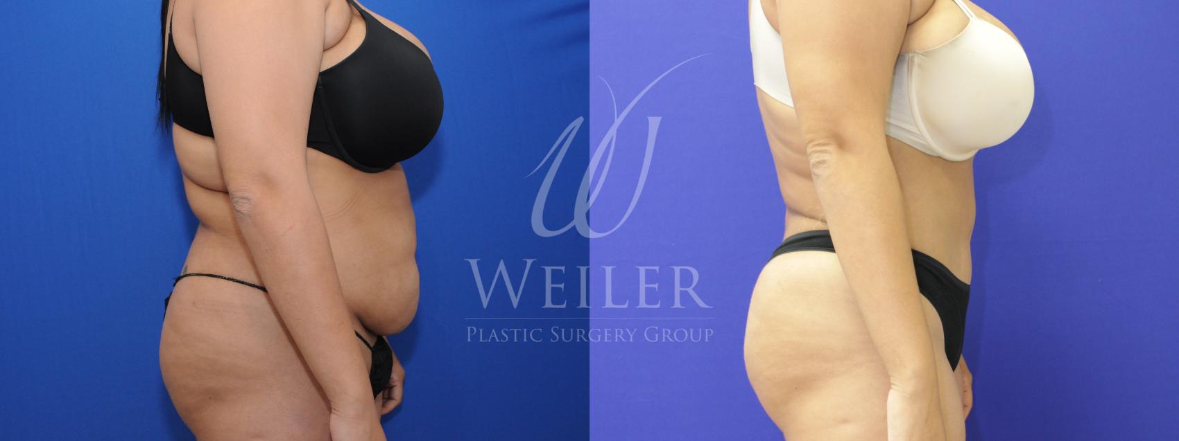 Before & After Tummy Tuck Case 779 Right Side View in Baton Rouge, Louisiana