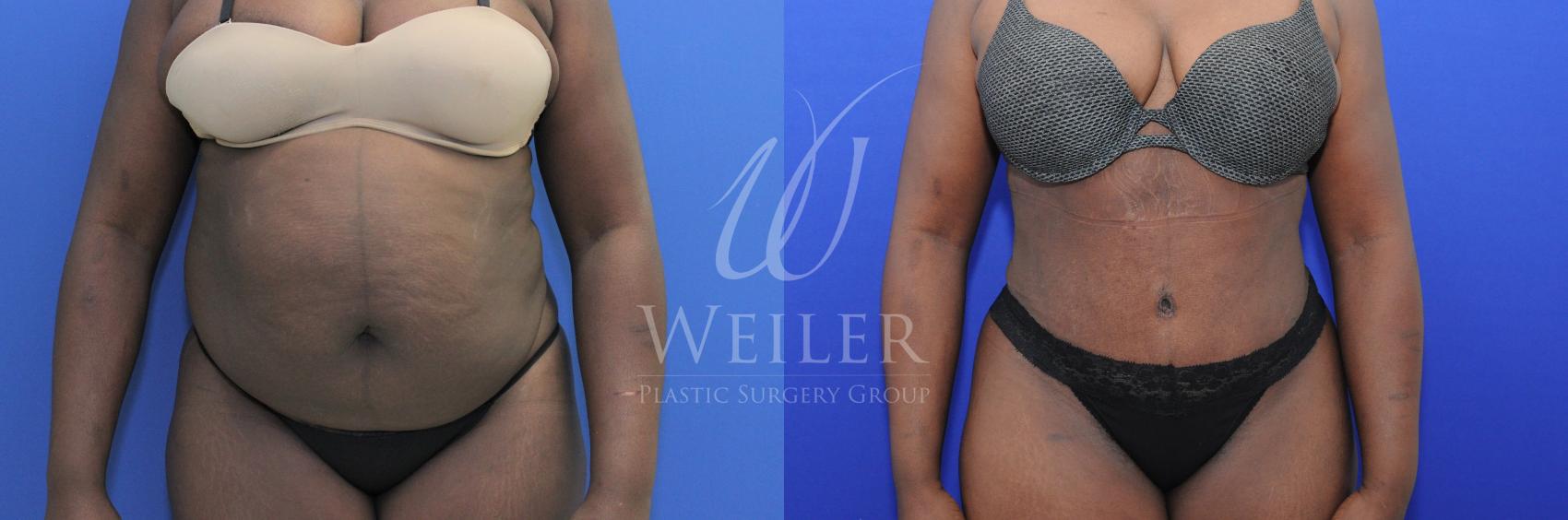 Before & After Tummy Tuck Case 780 Front View in Baton Rouge, Louisiana