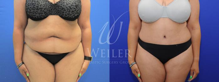 Before & After Tummy Tuck Case 781 Front View in Baton Rouge, Louisiana