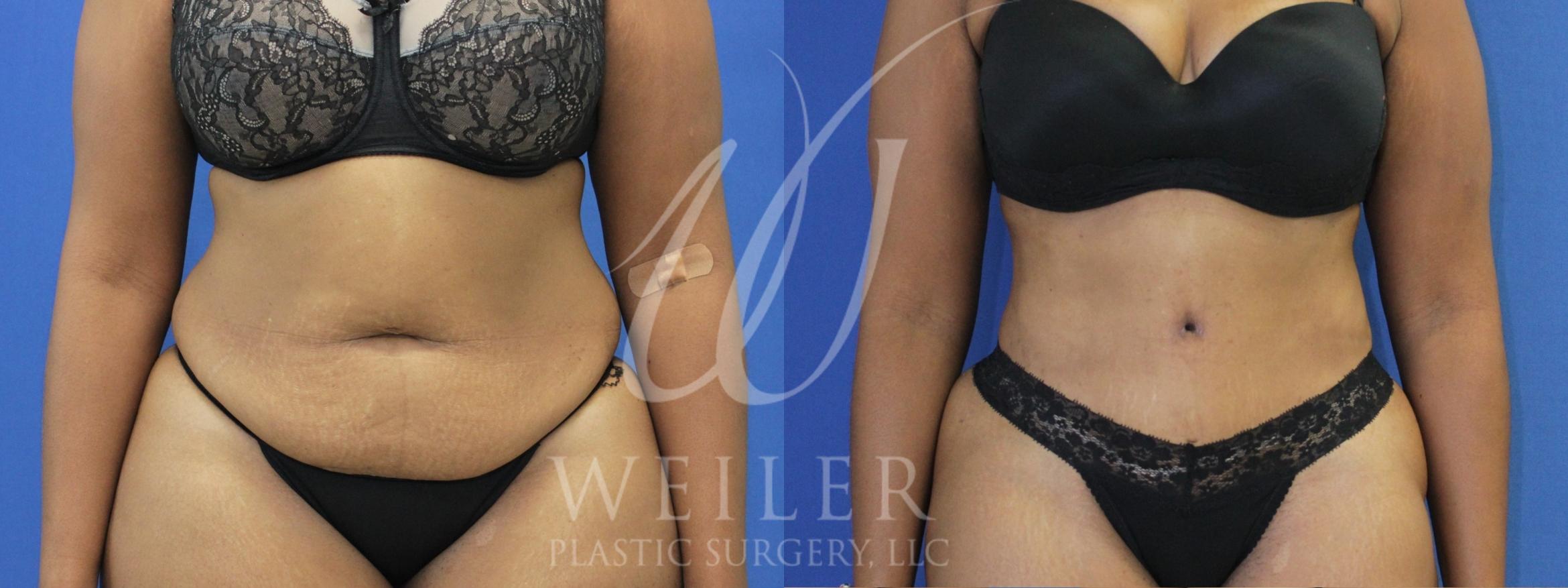 Before & After Tummy Tuck Case 782 Front View in Baton Rouge, Louisiana