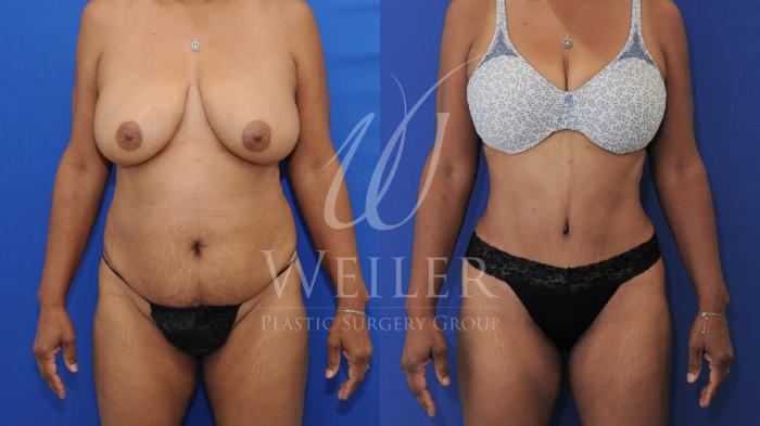 Before & After Tummy Tuck Case 783 Front View in Baton Rouge, Louisiana