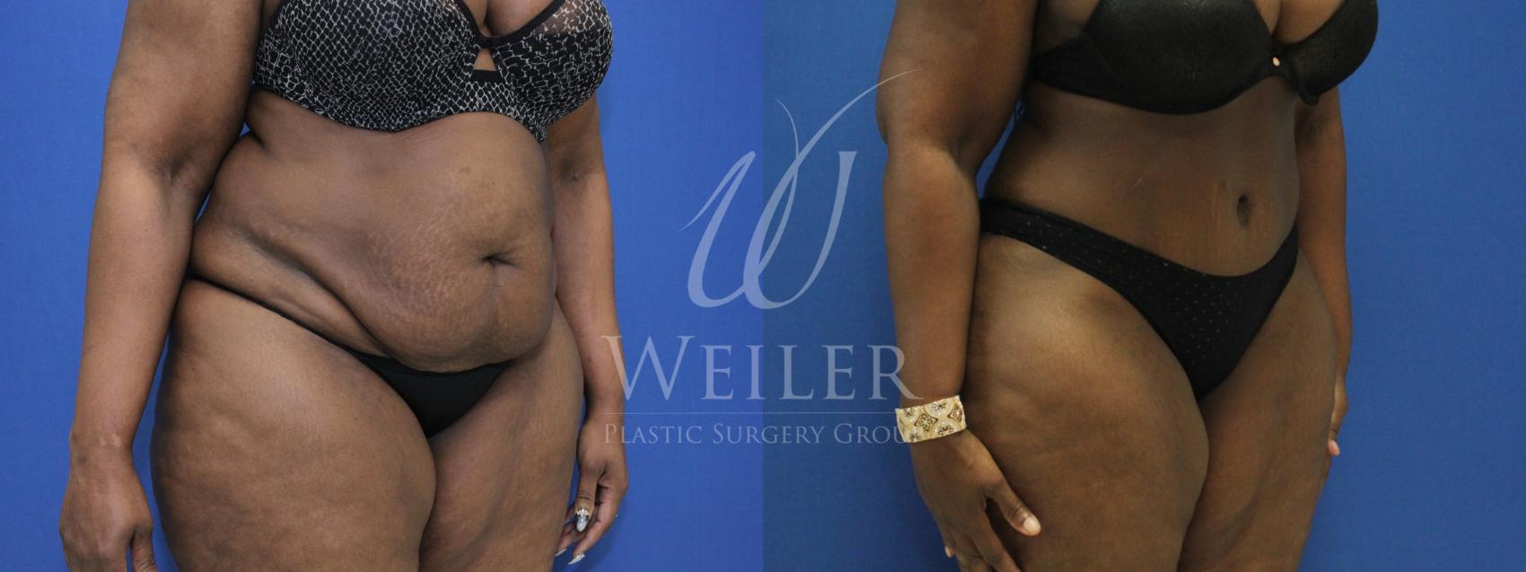 Before & After Tummy Tuck Case 784 Right Oblique View in Baton Rouge, New Orleans, & Lafayette, Louisiana