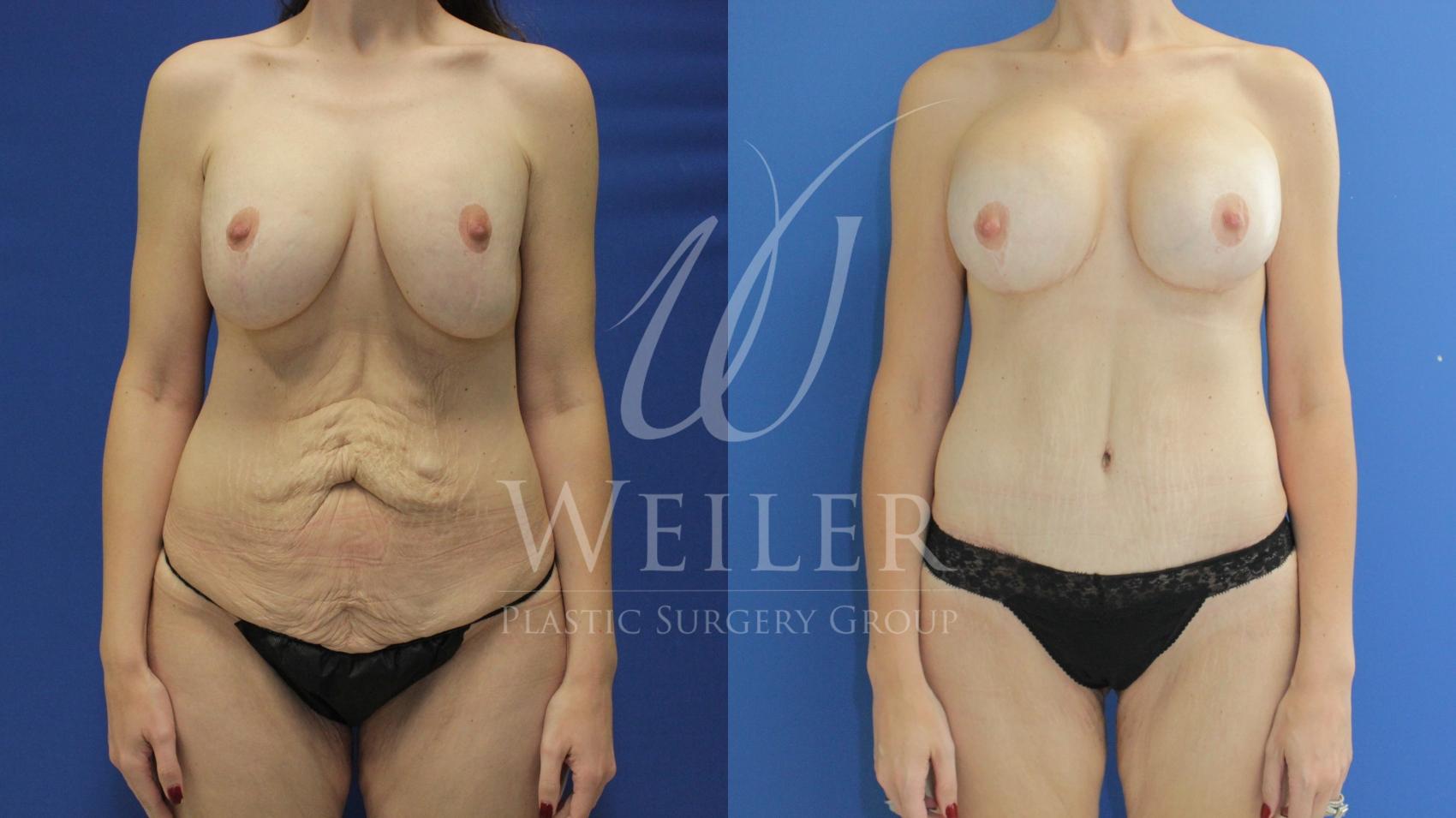 Before & After Tummy Tuck Case 788 Front View in Baton Rouge, Louisiana