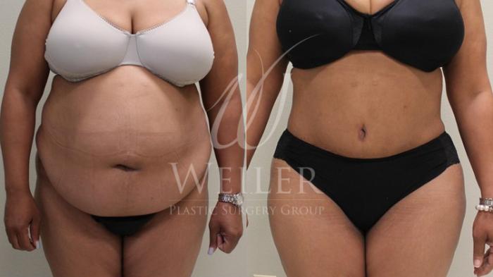 Before & After Tummy Tuck Case 80 View #1 View in Baton Rouge, Louisiana