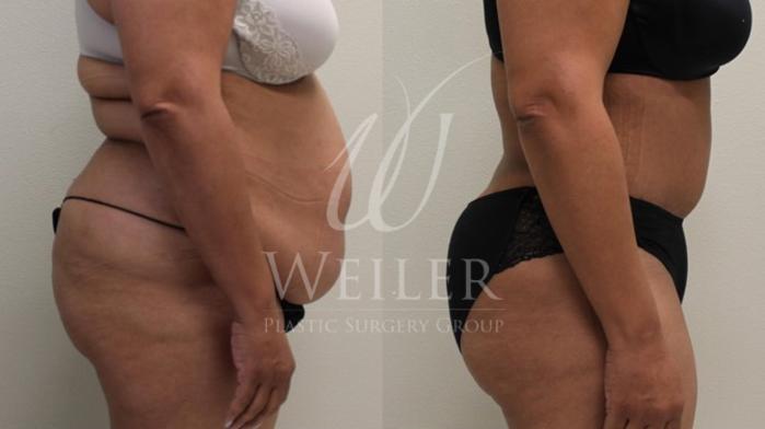 Before & After Tummy Tuck Case 80 View #2 View in Baton Rouge, Louisiana