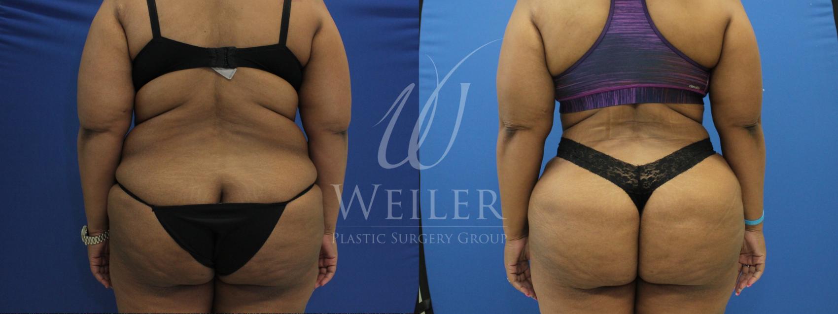 Before & After Tummy Tuck Case 812 Back View in Baton Rouge, Louisiana