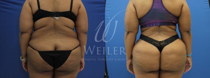 Before & After Tummy Tuck Case 812 Back View in Baton Rouge, New Orleans, & Lafayette, Louisiana