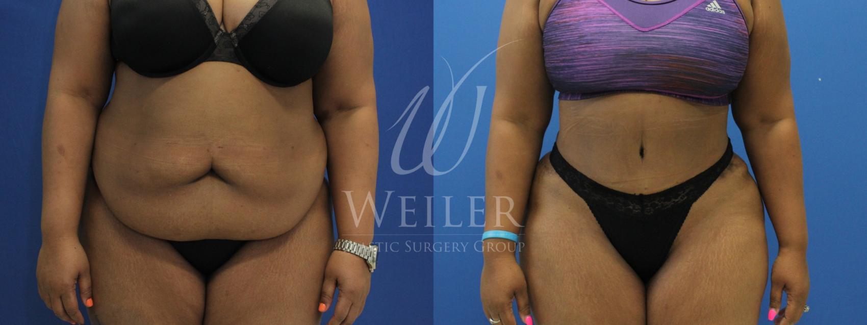 Before & After Tummy Tuck Case 812 Front View in Baton Rouge, Louisiana