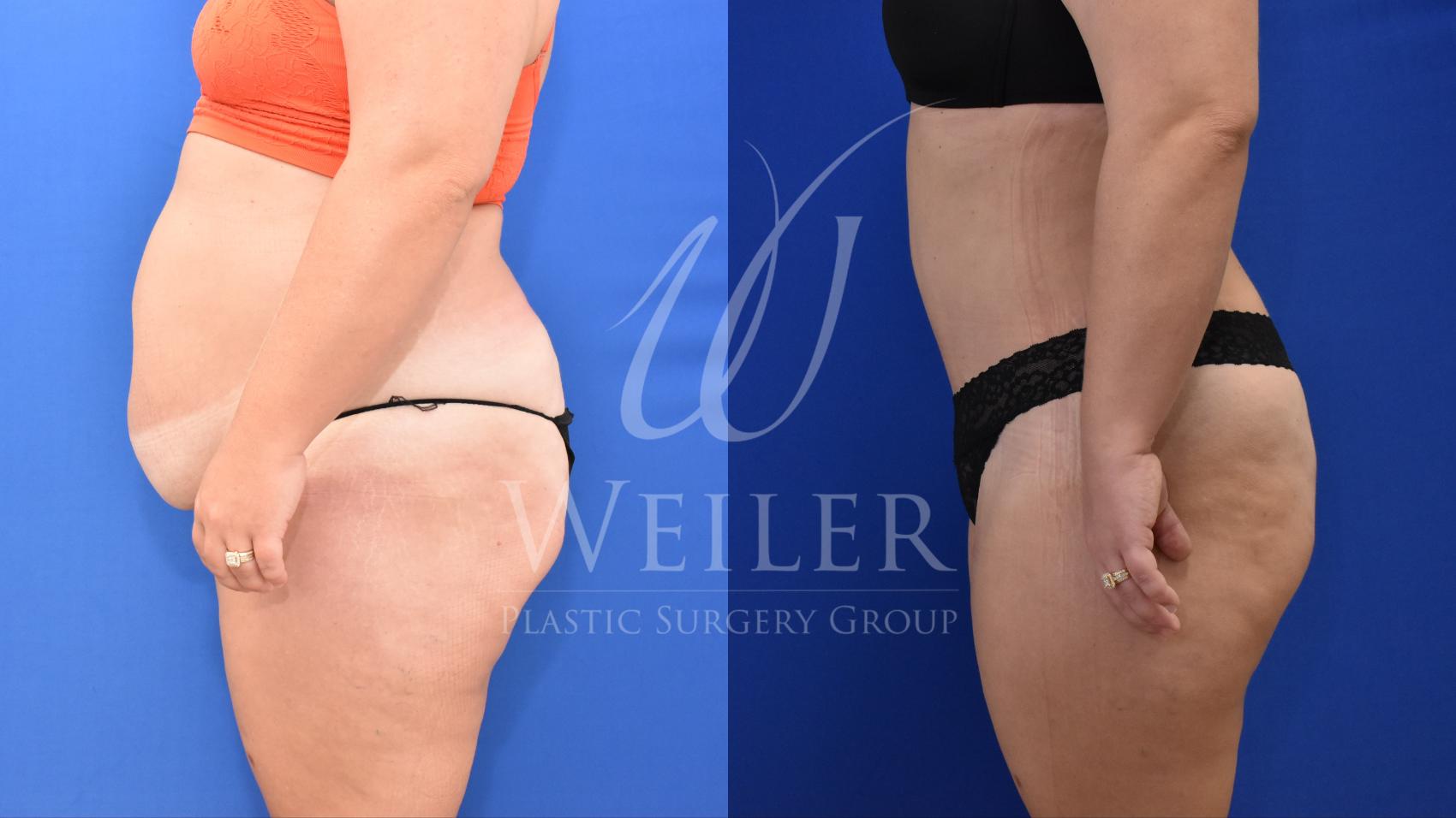Before & After Tummy Tuck Case 814 Left Side View in Baton Rouge, New Orleans, & Lafayette, Louisiana