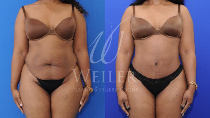 Before & After Tummy Tuck Case 822 Front View in Baton Rouge, Louisiana