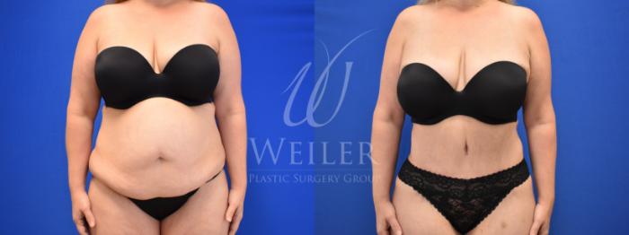 Before & After Tummy Tuck Case 827 Front View in Baton Rouge, New Orleans, & Lafayette, Louisiana
