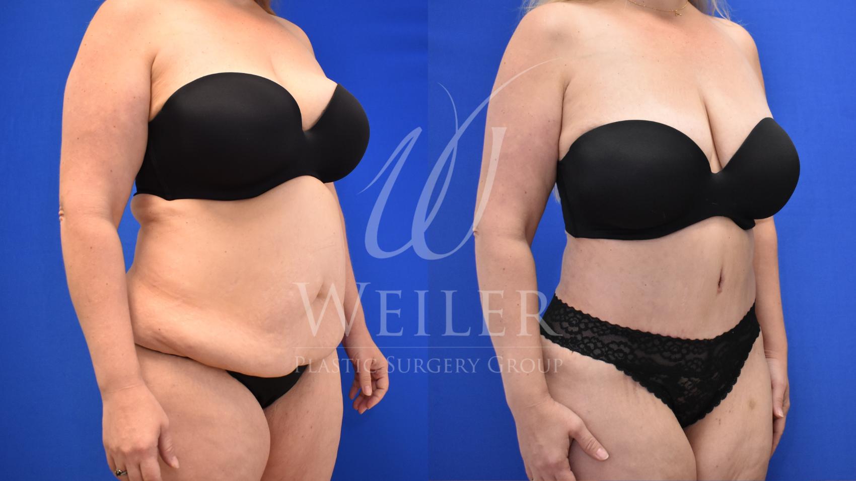 Before & After Tummy Tuck Case 827 Right Oblique View in Baton Rouge, New Orleans, & Lafayette, Louisiana