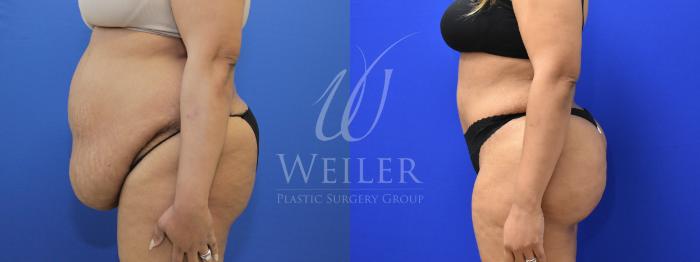 Before & After Tummy Tuck Case 829 Left Side View in Baton Rouge, Louisiana